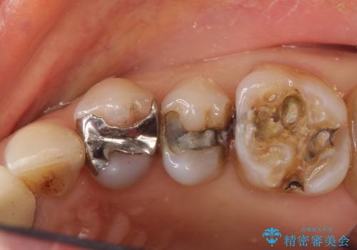 【オールセラミッククラウン】銀歯の下に大きな虫歯の治療前