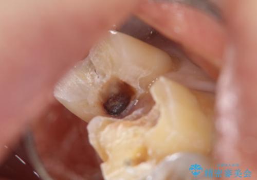 【オールセラミッククラン】銀歯の下に大きな虫歯の治療中
