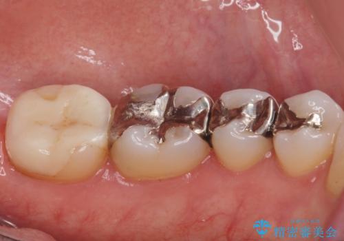 詰め物のやりかえ希望の治療前