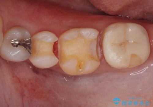 詰め物のやりかえ希望の治療中