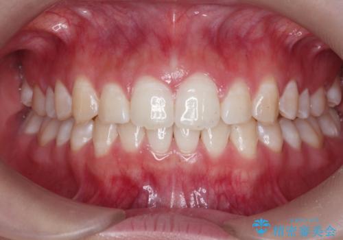 [ 正中離開の改善 ] マウスピース矯正で行う前歯の審美改善の症例 治療後