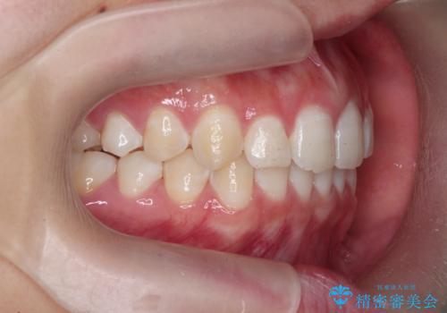 [ 正中離開の改善 ] マウスピース矯正で行う前歯の審美改善の治療後
