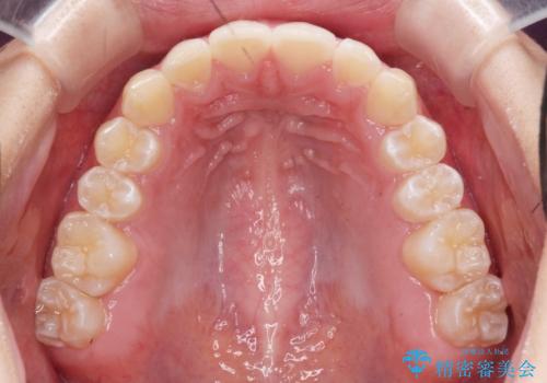[ 正中離開の改善 ] マウスピース矯正で行う前歯の審美改善の治療後