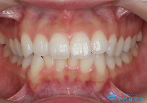 歯を抜かずに後方移動で達成する、前突感の改善の症例 治療前