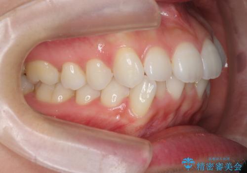 歯を抜かずに後方移動で達成する、前突感の改善の治療前