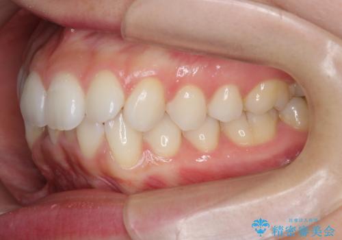 歯を抜かずに後方移動で達成する、前突感の改善の治療前