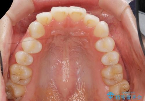 歯を抜かずに後方移動で達成する、前突感の改善の治療前