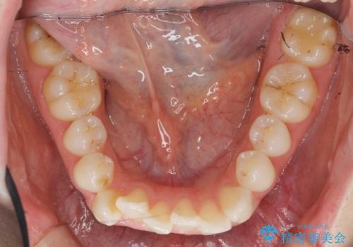 歯を抜かずに後方移動で達成する、前突感の改善の治療前