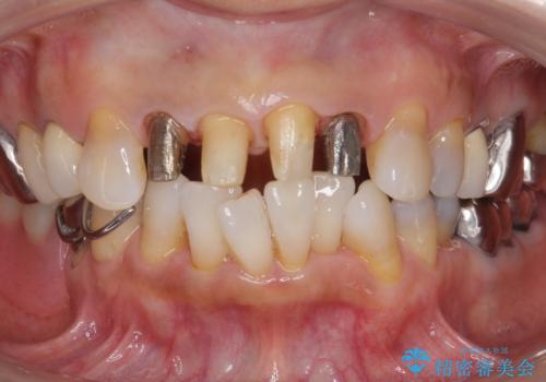 50代女性 前歯のつめものがとれた これを機に前歯をきれいにしたいの治療中