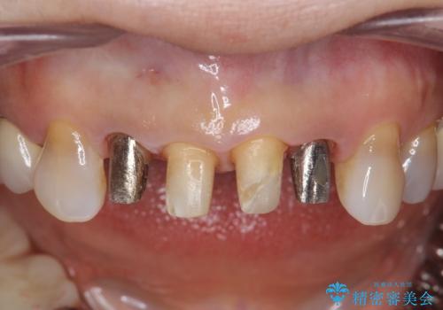 50代女性 前歯のつめものがとれた これを機に前歯をきれいにしたいの治療中
