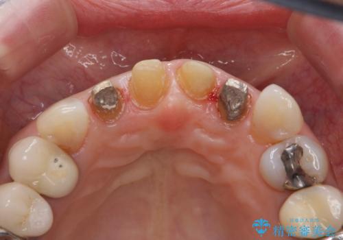 50代女性 前歯のつめものがとれた これを機に前歯をきれいにしたいの治療中