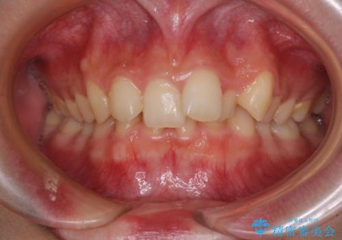 【モニター】下顎前歯の2本欠損　上顎のみの抜歯でバランスを取ったワイヤー矯正の症例 治療前