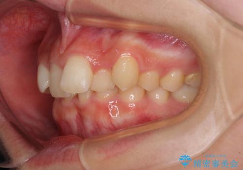 【モニター】下顎前歯の2本欠損　上顎のみの抜歯でバランスを取ったワイヤー矯正の治療前