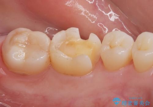 e-maxインレー治療の治療中