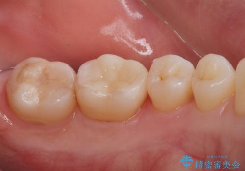 e-maxインレー治療の治療後