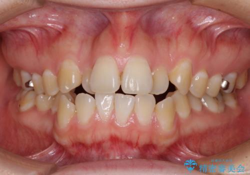 舌突出癖による開咬　舌のトレーニングを行いながら咬み合わせを改善の症例 治療前