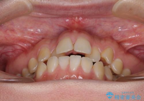舌突出癖による開咬 舌のトレーニングを行いながら咬み合わせを改善の治療前