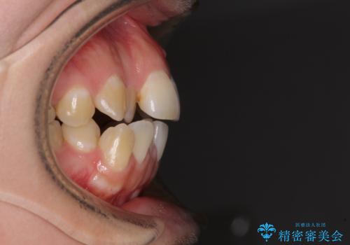 舌突出癖による開咬　舌のトレーニングを行いながら咬み合わせを改善の治療前