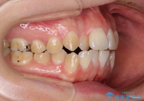 舌突出癖による開咬 舌のトレーニングを行いながら咬み合わせを改善の治療前