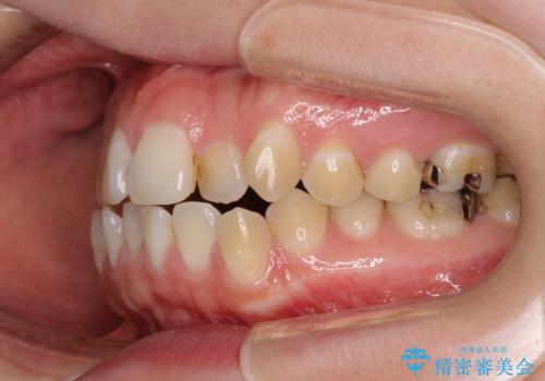 舌突出癖による開咬 舌のトレーニングを行いながら咬み合わせを改善の治療前