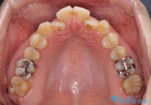 舌突出癖による開咬 舌のトレーニングを行いながら咬み合わせを改善の治療前
