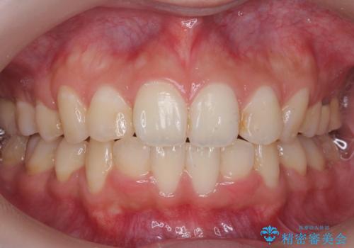 口元大事です! 見違える矯正!! 乱ぐい歯もあきらめないでください。の症例 治療後