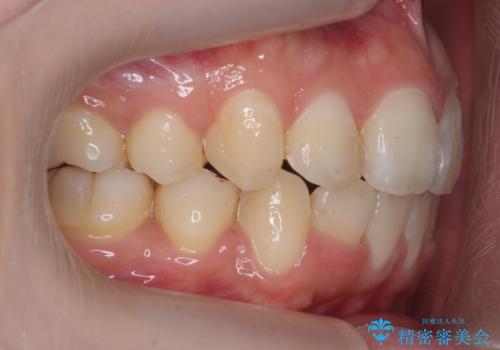 口元大事です! 見違える矯正!! 乱ぐい歯もあきらめないでください。の治療後