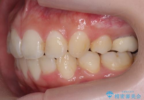 口元大事です! 見違える矯正!! 乱ぐい歯もあきらめないでください。の治療後