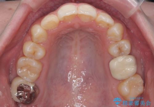 口元大事です! 見違える矯正!! 乱ぐい歯もあきらめないでください。の治療後