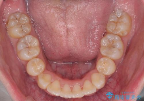 口元大事です! 見違える矯正!! 乱ぐい歯もあきらめないでください。の治療後