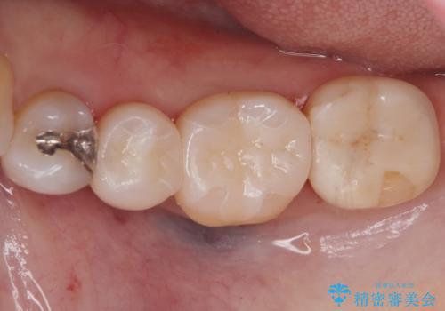 詰め物のやりかえ希望の治療後