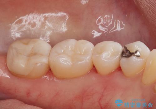 詰め物のやりかえ希望の治療後