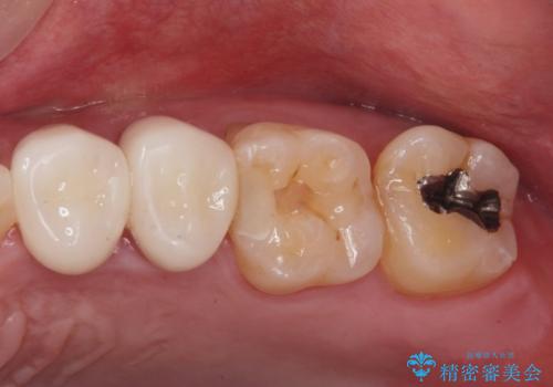 銀が目立つので白くしたいの症例 治療後
