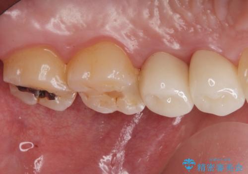 銀が目立つので白くしたいの治療後