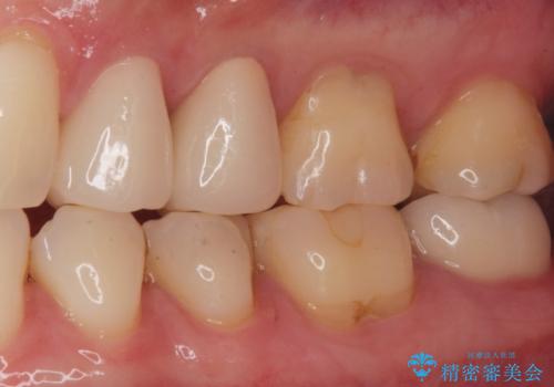 銀が目立つので白くしたいの治療後