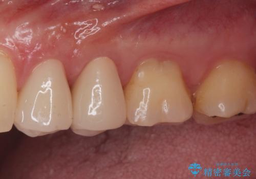 銀が目立つので白くしたいの治療後