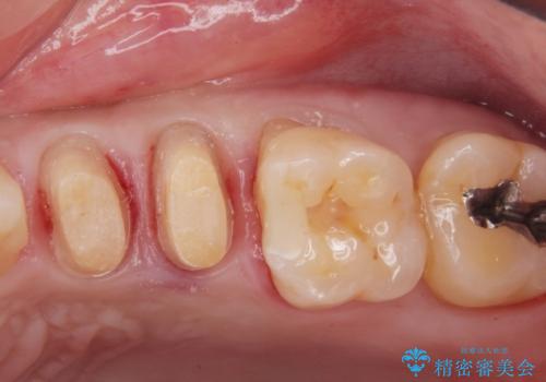 銀が目立つので白くしたいの治療中