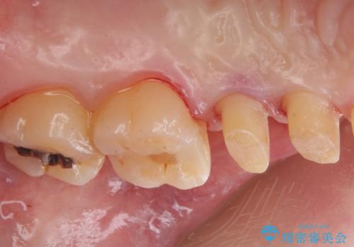 銀が目立つので白くしたいの治療中