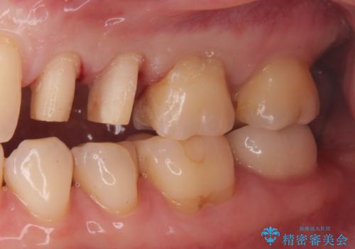 銀が目立つので白くしたいの治療中
