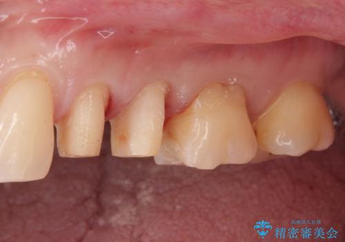 銀が目立つので白くしたいの治療中