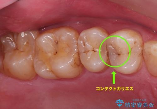 歯と歯の間の虫歯(コンタクトカリエス)の症例 治療前