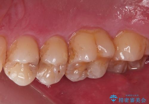 歯と歯の間の虫歯(コンタクトカリエス)の治療前