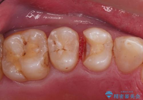 歯と歯の間の虫歯(コンタクトカリエス)の治療中