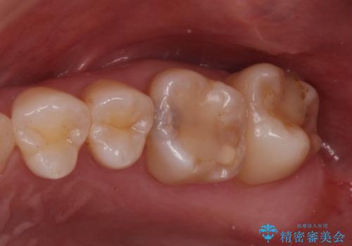 奥歯の治療の劣化が気になる。ザラザラしているの症例 治療前