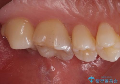 奥歯の治療の劣化が気になる。ザラザラしているの治療前