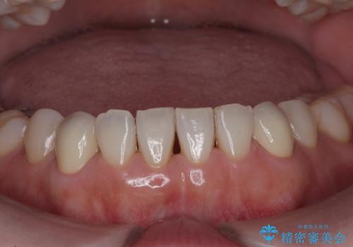 他院で矯正後、歯の神経が死んでしまった歯の治療 の治療後