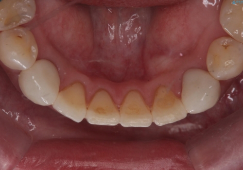 他院で矯正後、歯の神経が死んでしまった歯の治療 の治療後