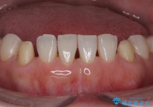 他院で矯正後、歯の神経が死んでしまった歯の治療 の治療中