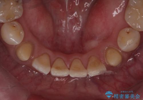 他院で矯正後、歯の神経が死んでしまった歯の治療 の治療中