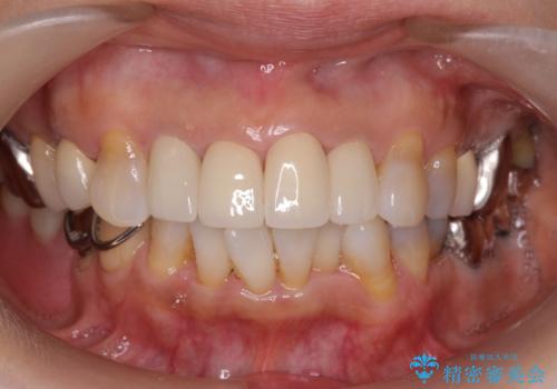 50代女性 前歯のつめものがとれた これを機に前歯をきれいにしたいの治療後